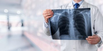Community Acquired Pneumonia Treatment