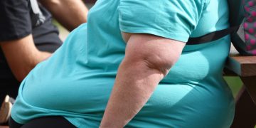 morbid obesity