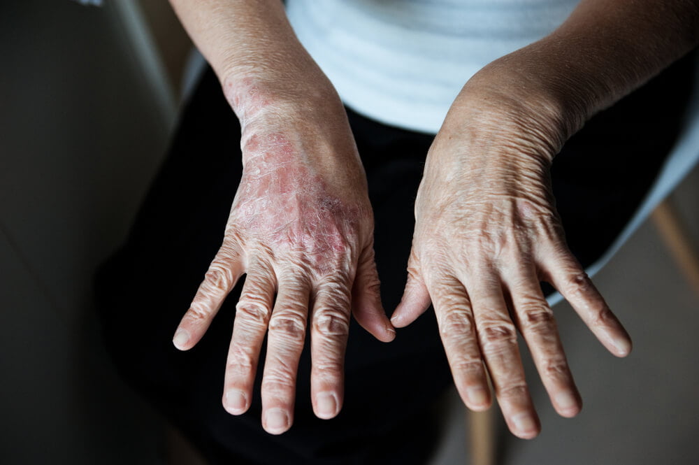 psoriasis people