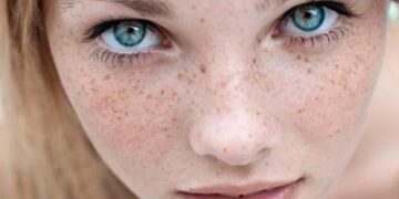 How Are Freckles On The Face?  Herbal Remedy For Freckles On The Face