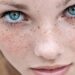 How Are Freckles On The Face?  Herbal Remedy For Freckles On The Face