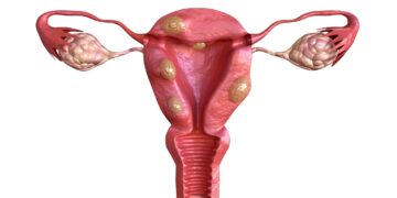 IVI studies the use of radiofrequency to treat uterine fibroids