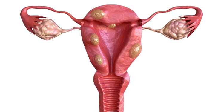 IVI studies the use of radiofrequency to treat uterine fibroids