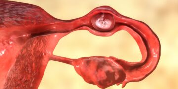 Ectopic pregnancy and fertility – IVI